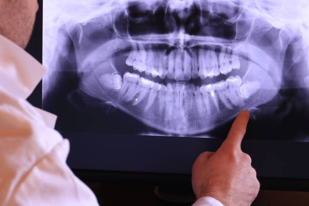 Best Emergency Wisdom Teeth Removal in Myerstown, PA